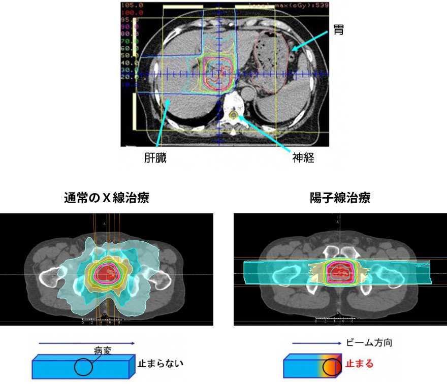 放射線治療イメージ